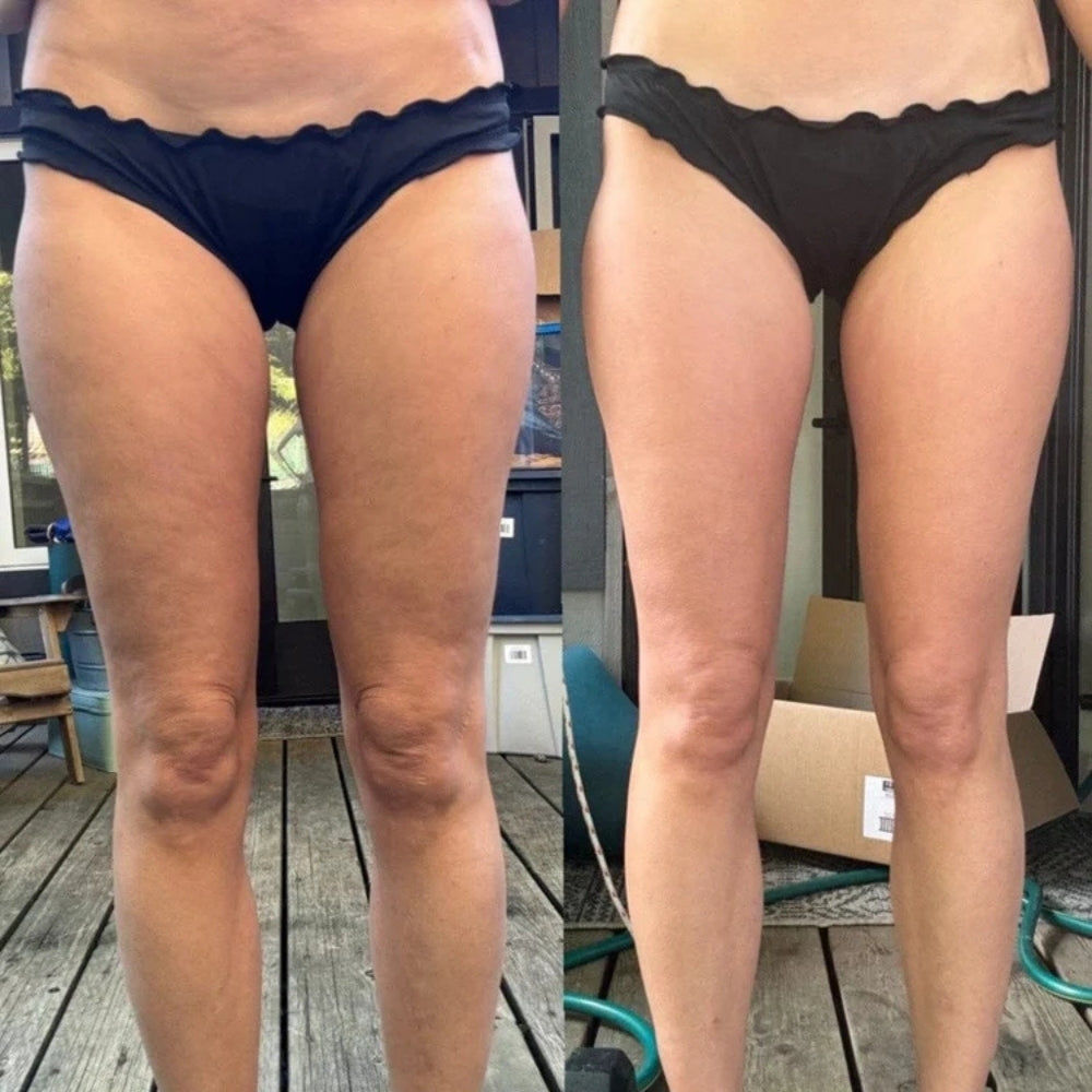 BeauLift™ - Anti-Cellulite Massager